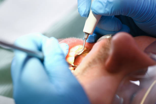 Best Emergency Dentist for Lost Fillings or Crowns in Loudon, TN